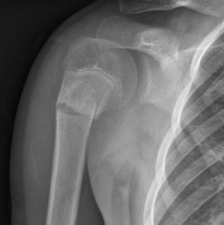 Paeds Shoulder Fracture